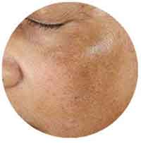 Get rid your melasma now