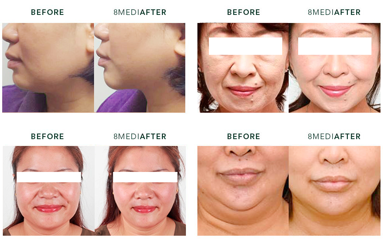 Skin tightening treatment before and after